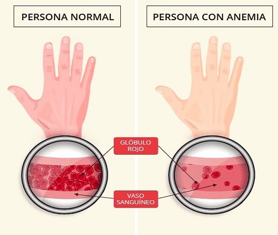 Anemia